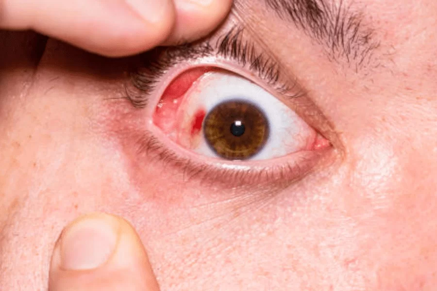 spiritual meaning of broken blood vessel in eye